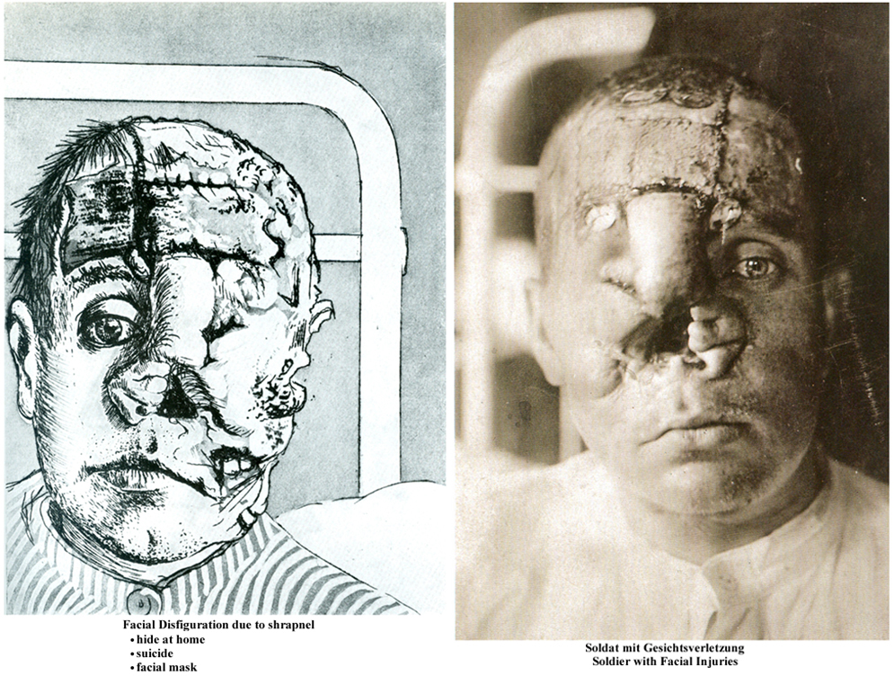 Facial disfigurement schrapnel Otto Dix 40